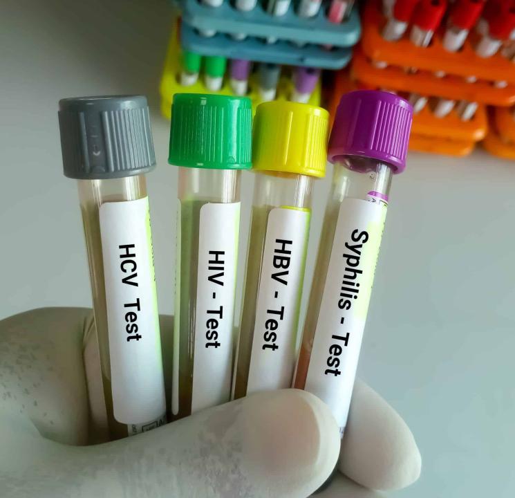 Scientist hold blood samples tube for Sexuallly Transmitted Disease. Syphilis,  HBV, HIV, HCV